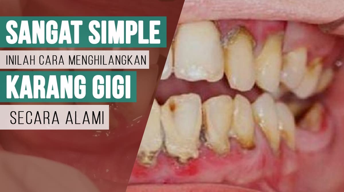 Sangat Simple, Inilah Cara menghilangkan Karang Gigi Secara Alami