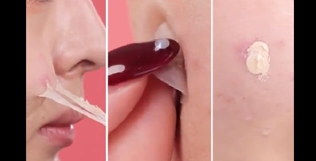 4 Tanda Jerawat di Wajahmu Masuk Kategori Parah, Lakukan Segara Hal Ini