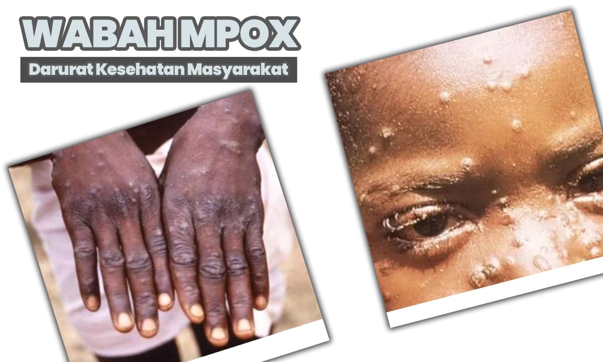 WHO Umumkan Wabah Mpox di Afrika sebagai Darurat Kesehatan Global