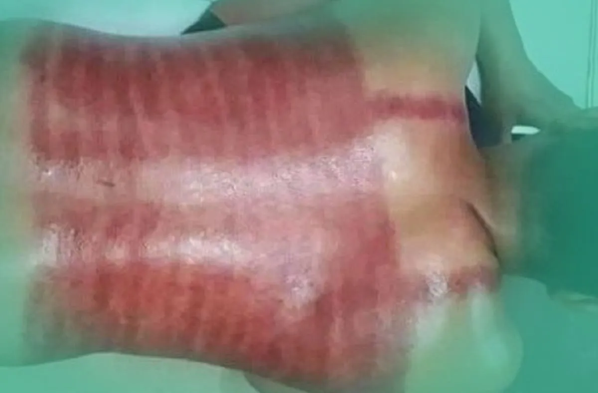 Bagi Yang Sering Kerokan Hati-Hati, Ini Bahaya Kerokan dan Dampaknya Jika Terus Menerus