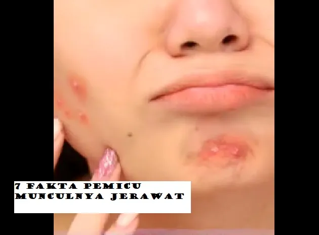 7 Fakta Pemicu Jerawat, Lakukan Segera Hal Ini dan Jangan Termakan Iklan