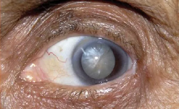 Bhakti Sosial Operasi Katarak di gelar RSUD Bengkulu Tengah.