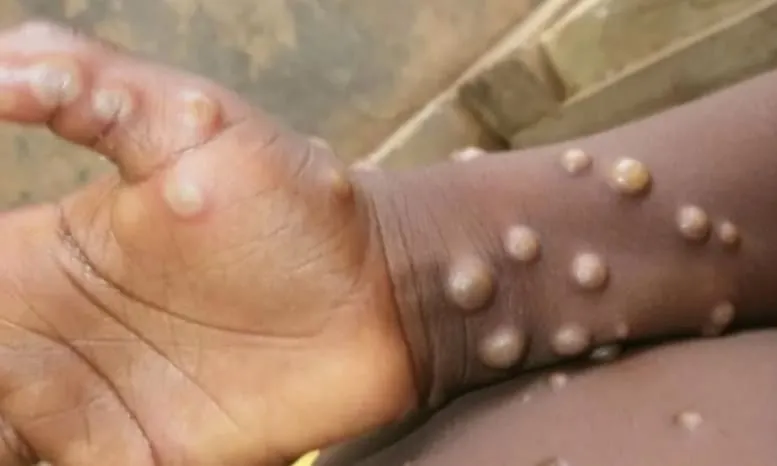 Cacar monyet atau Mpox kembali menjadi perhatian utama di Indonesia